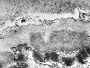 M,53y. | type III membranoproliferative glomerulonephritis